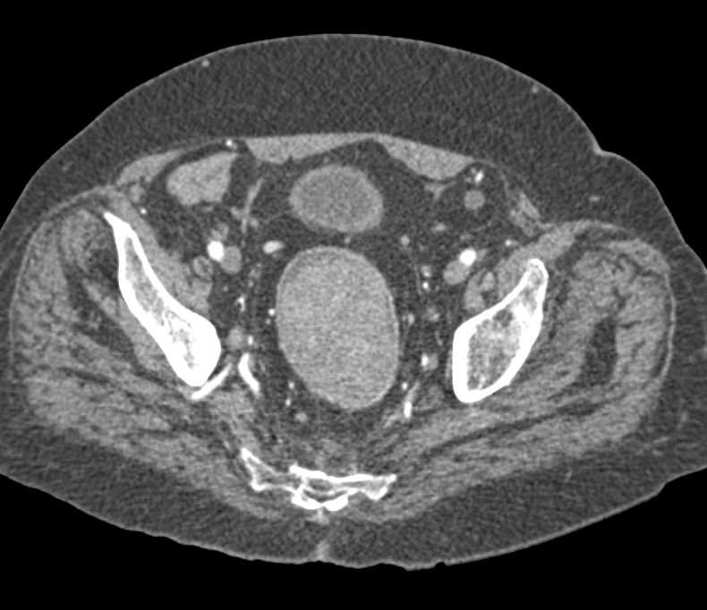 Bulky Rectal Cancer on CT - CTisus CT Scan