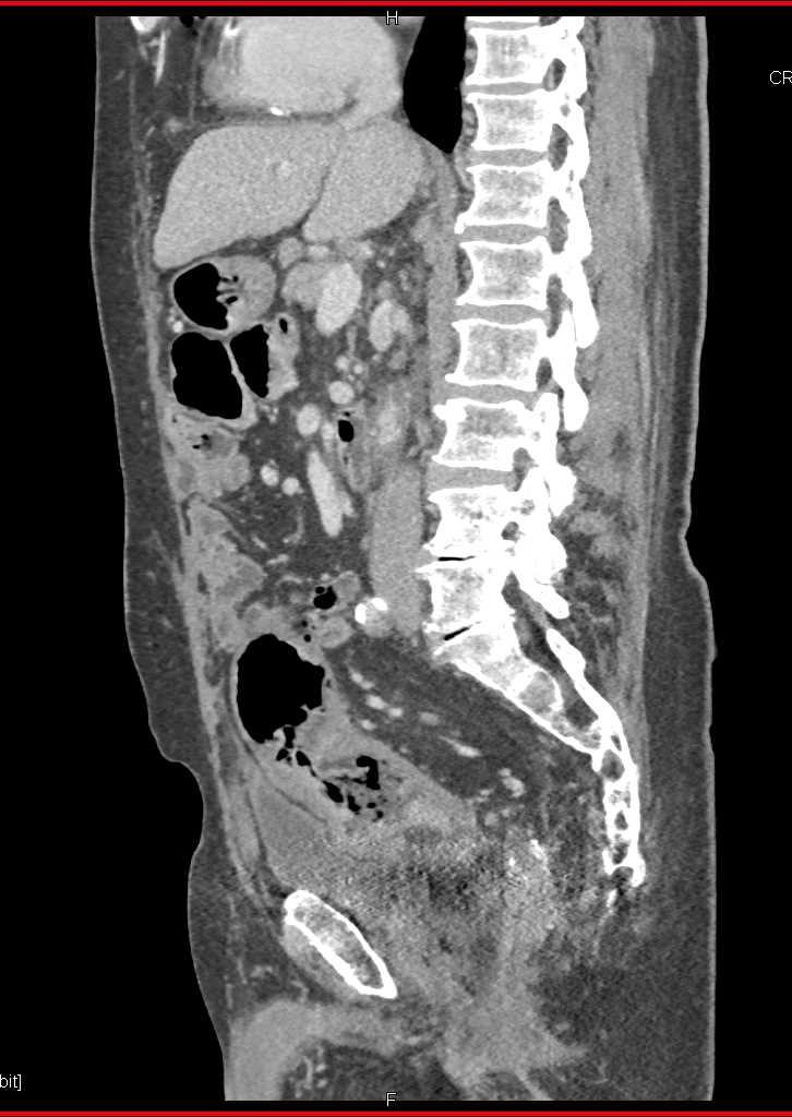 Ulcerating Colon Cancer in the Sigmoid Colon - CTisus CT Scan