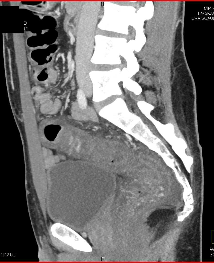 Infiltrating Rectal Cancer with Local Spread - CTisus CT Scan