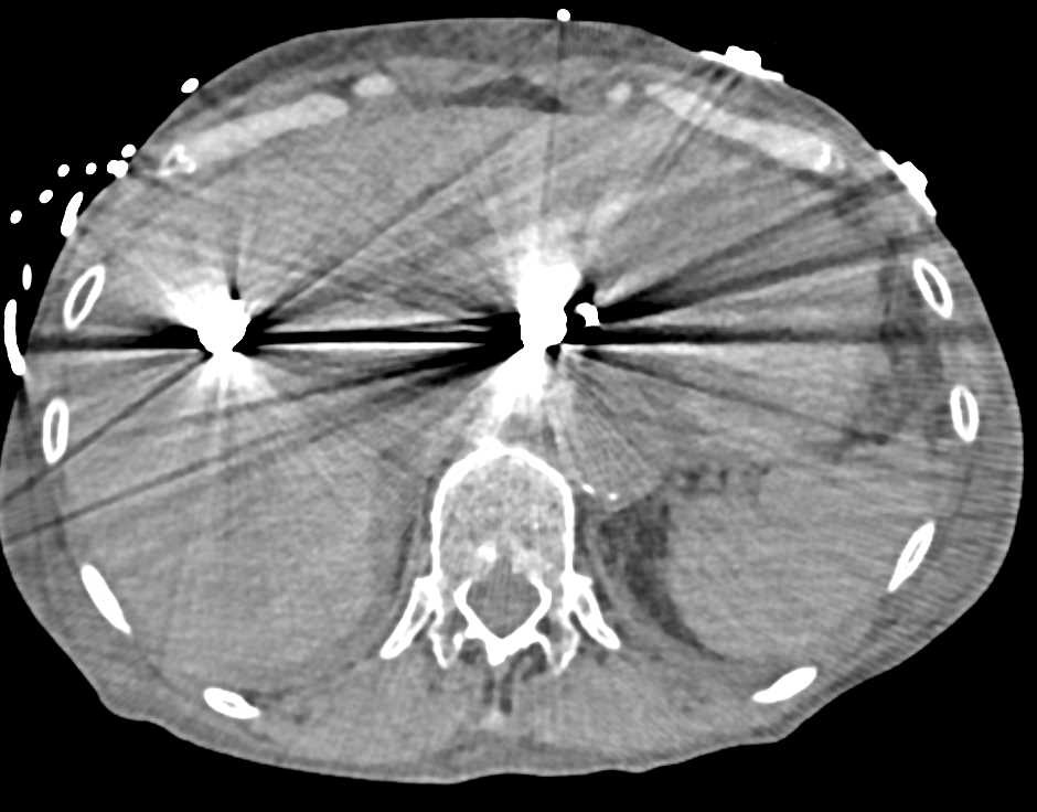 Pseudomembranous Colitis - CTisus CT Scan