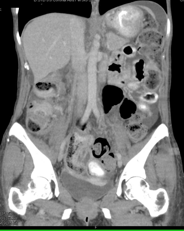 Rectal Cancer and Carcinomatosis - CTisus CT Scan