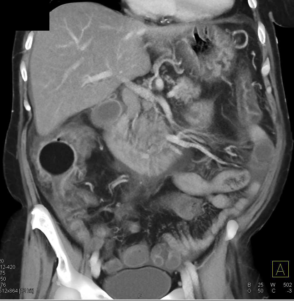 Incidental Colonic Lipoma in a Patient with Pseudomembranous Colitis (PMC) - CTisus CT Scan