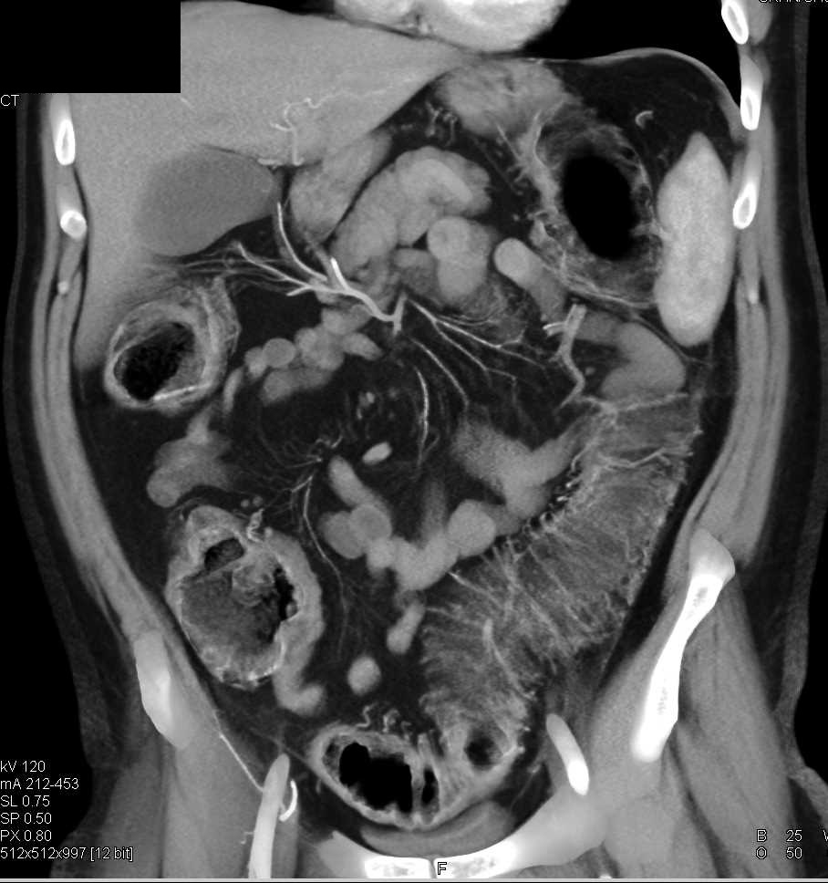 Ulcerative Colitis - CTisus CT Scan