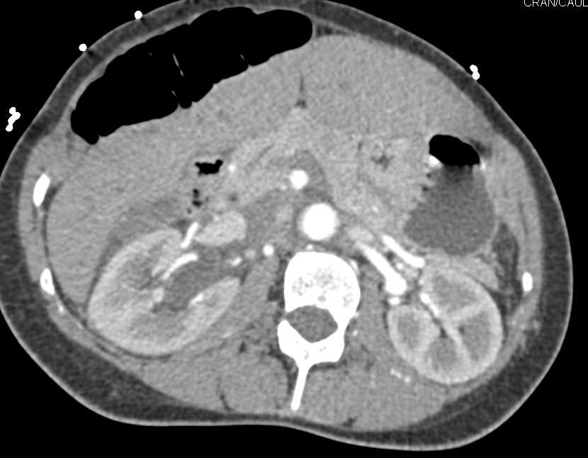 Infiltrating Colon Cancer - CTisus CT Scan