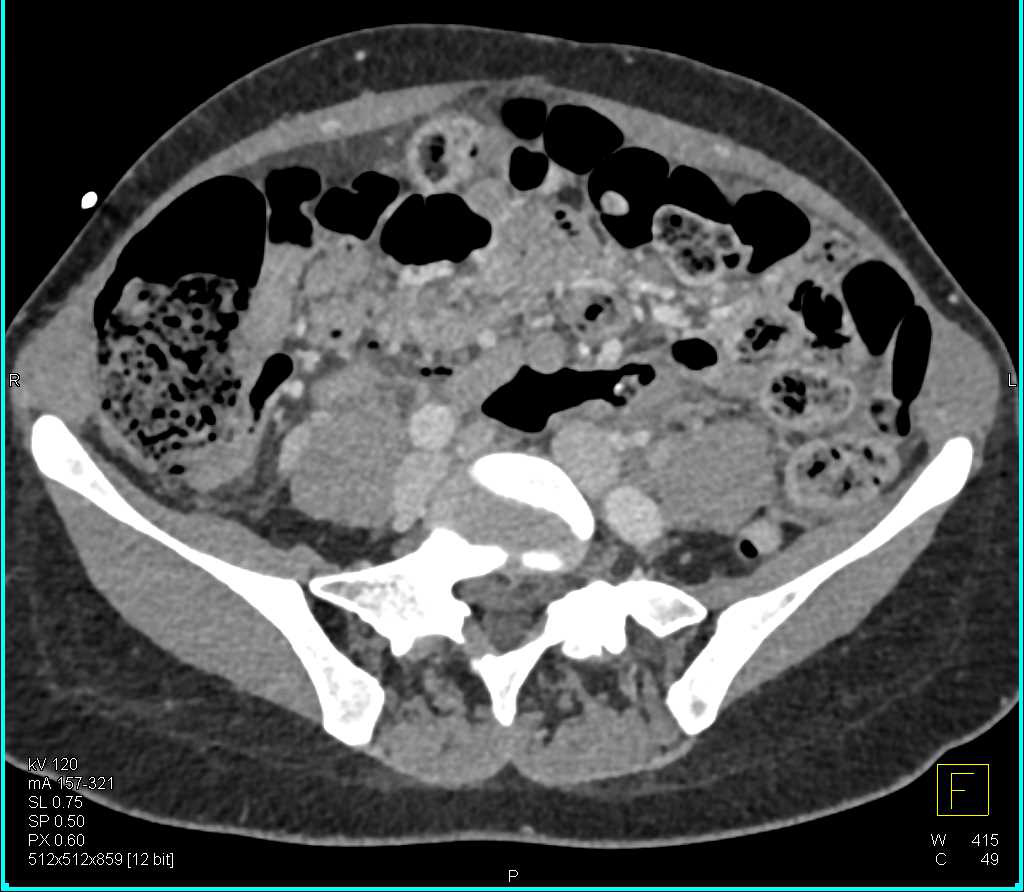 Ct Scan With Contrast Show Colon Cancer