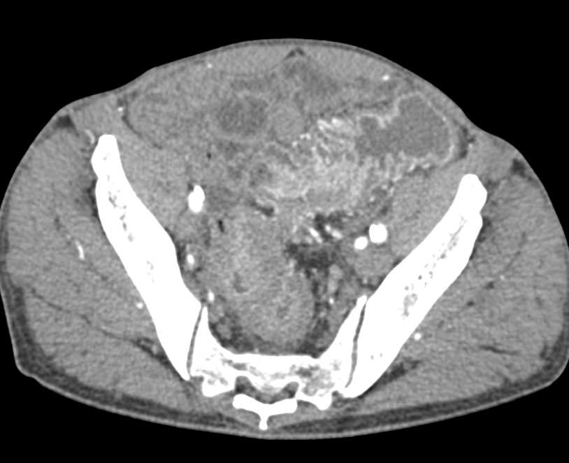 Colitis Sigmoid Colon - CTisus CT Scan