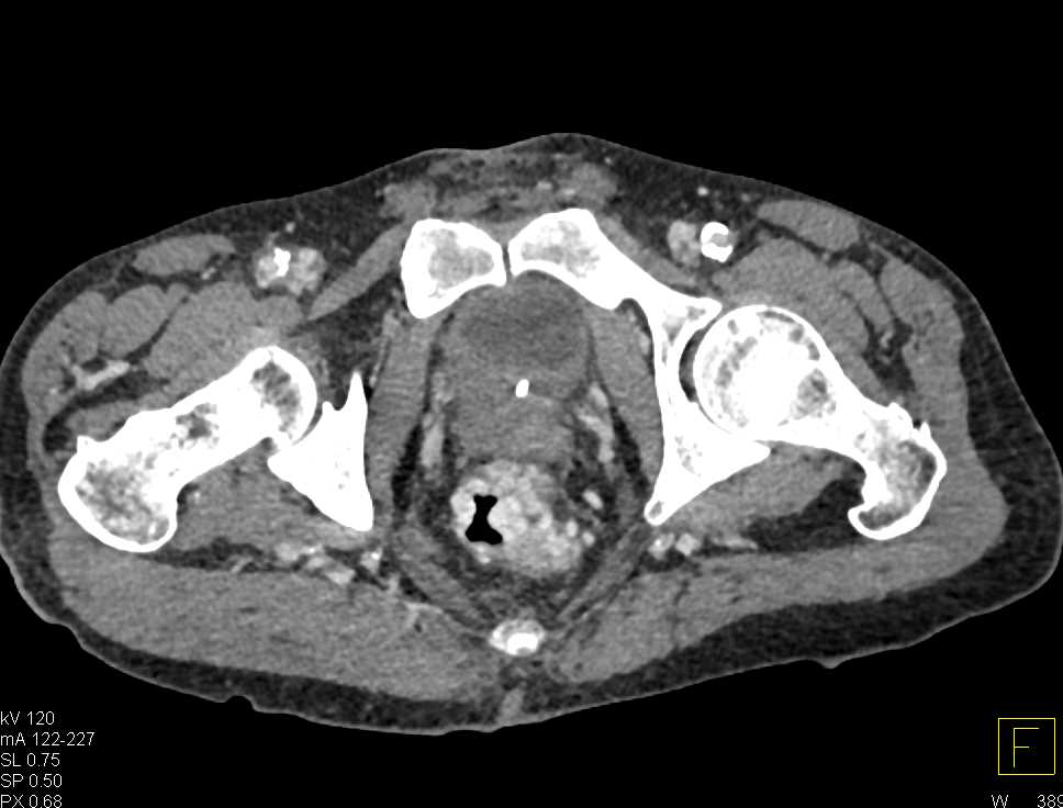 Gastrointestinal (GI) Bleed due to Large Rectal Varices with CTA - CTisus CT Scan