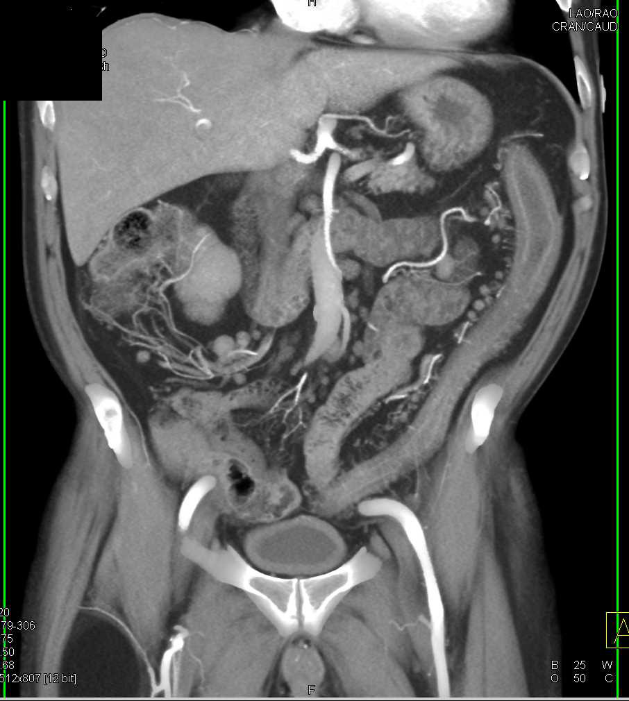 Active Ulcerative Colitis Involves the Left Colon - CTisus CT Scan