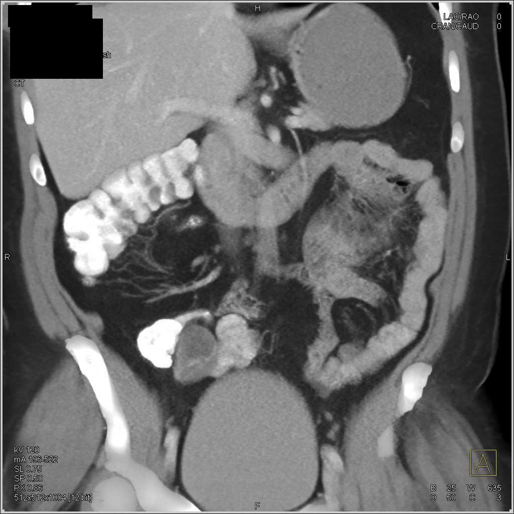 Mucocele of the Appendix - CTisus CT Scan