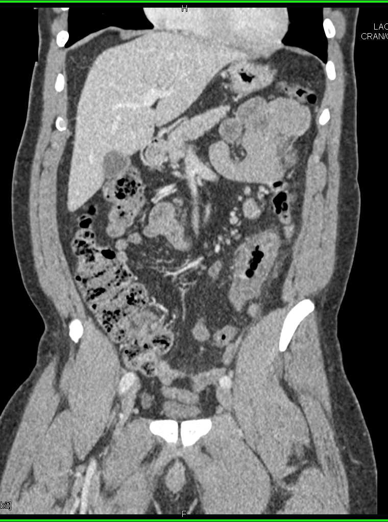 Diverticulitis Descending Colon - CTisus CT Scan