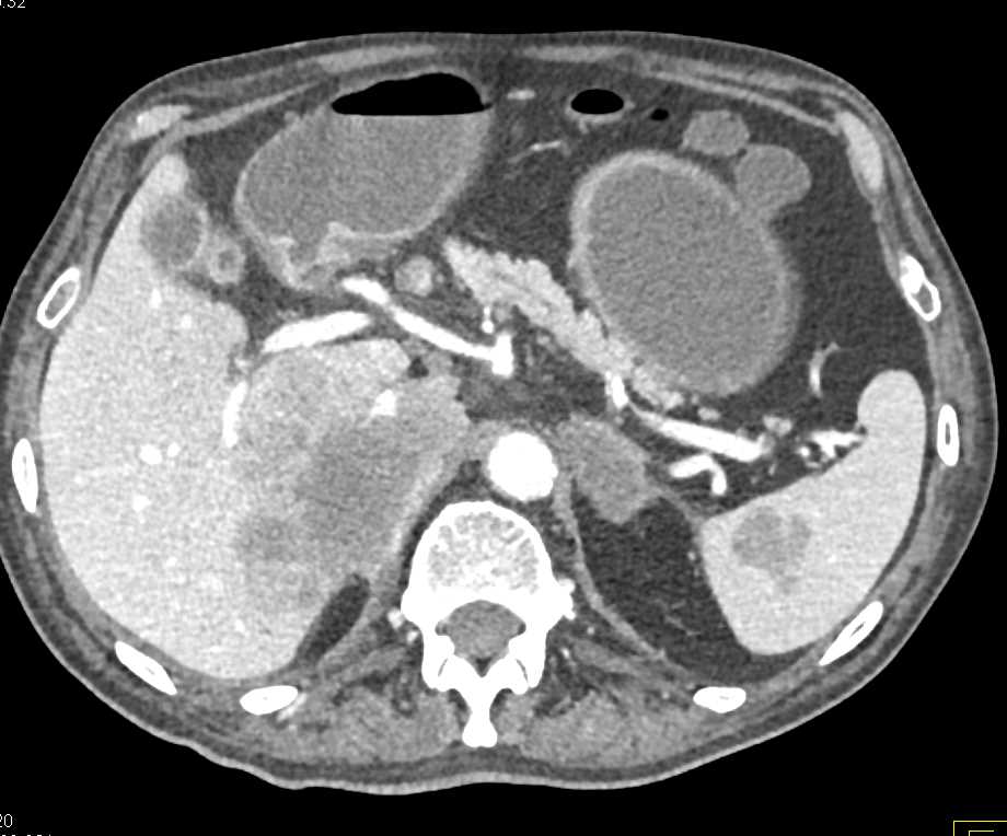 Pneumatosis Coli Best Seen on Lung Windows - CTisus CT Scan