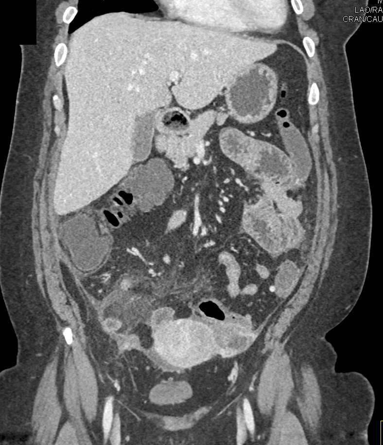 Acute Appendicitis - CTisus CT Scan