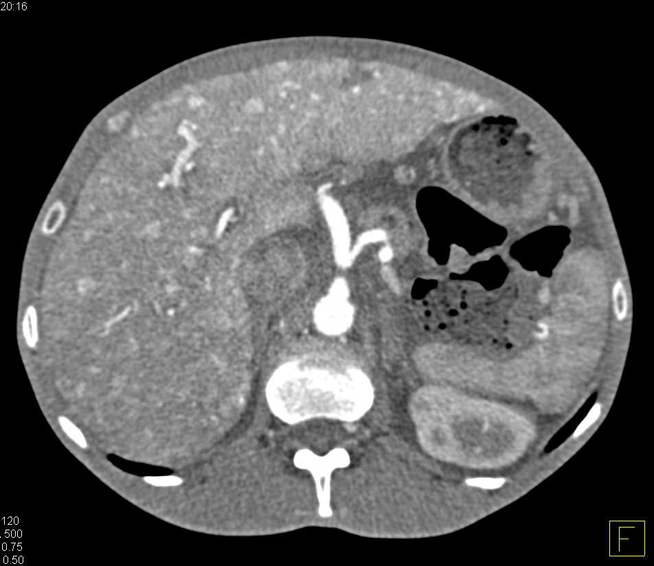 Pseudomembranous Colitis Involves the Cecum - CTisus CT Scan