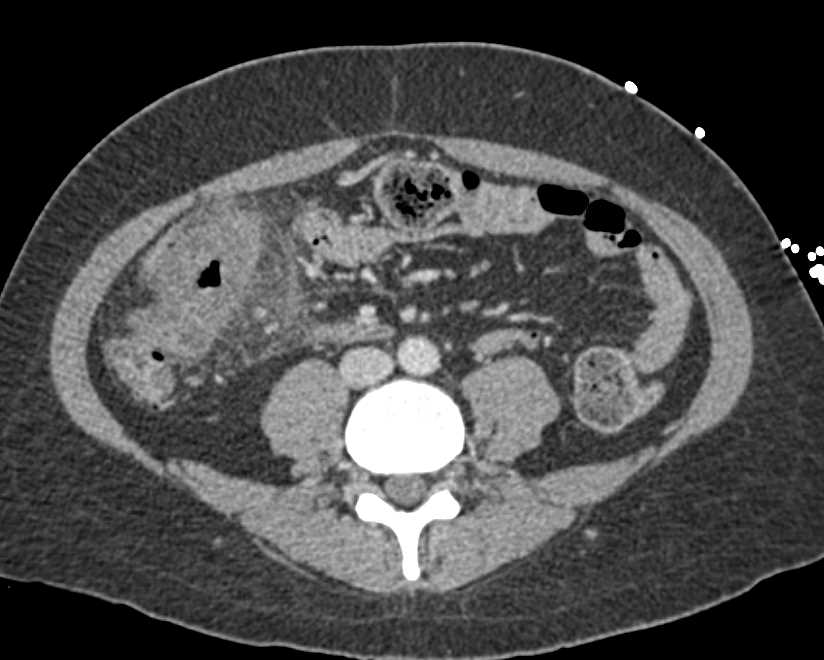 Infectious Colitis Right Colon can be Confused with Carcinoma - CTisus CT Scan