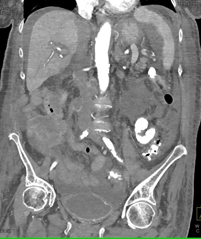 Pseudomembranous Colitis in a Pancreatic Cancer Patient - CTisus CT Scan