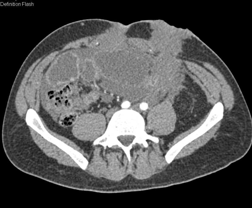 Carcinomatosis and Small Bowel Obstruction (SBO) due to Recurrent Rectal Cancer - CTisus CT Scan