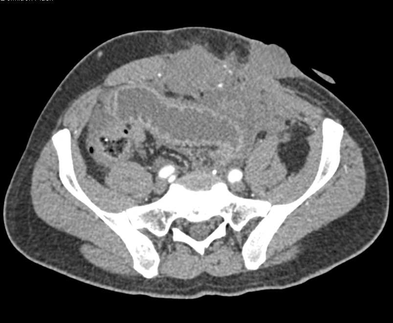 Carcinomatosis and Small Bowel Obstruction (SBO) due to Recurrent Rectal Cancer - CTisus CT Scan