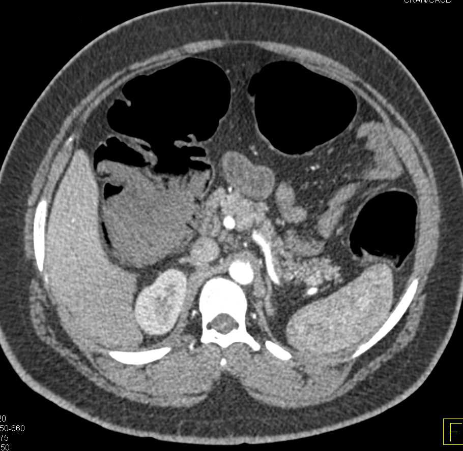 Pneumatosis Coli Best Seen On Lung Windows Colon Case Studies