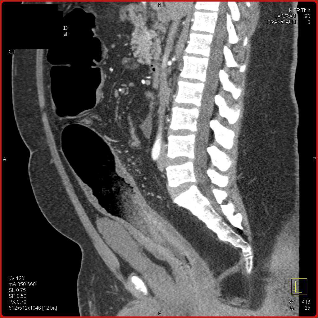 Pneumatosis Right Colon with Severe Colitis Rectum - CTisus CT Scan