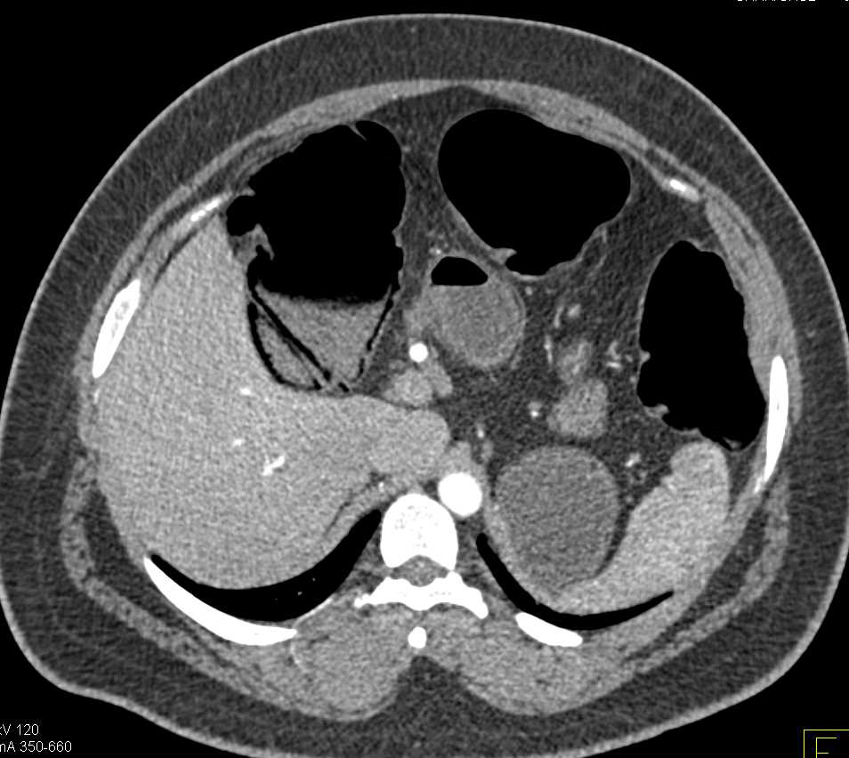 Pneumatosis Right Colon with Severe Colitis Rectum - CTisus CT Scan