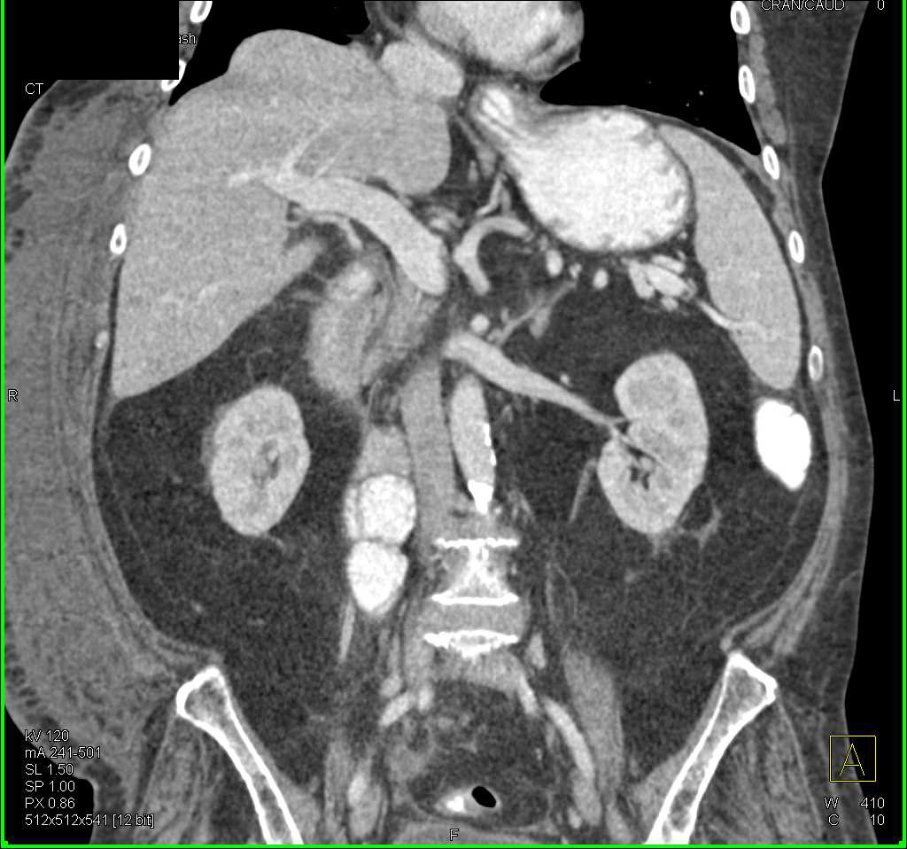 Cecal Volvulus - CTisus CT Scan