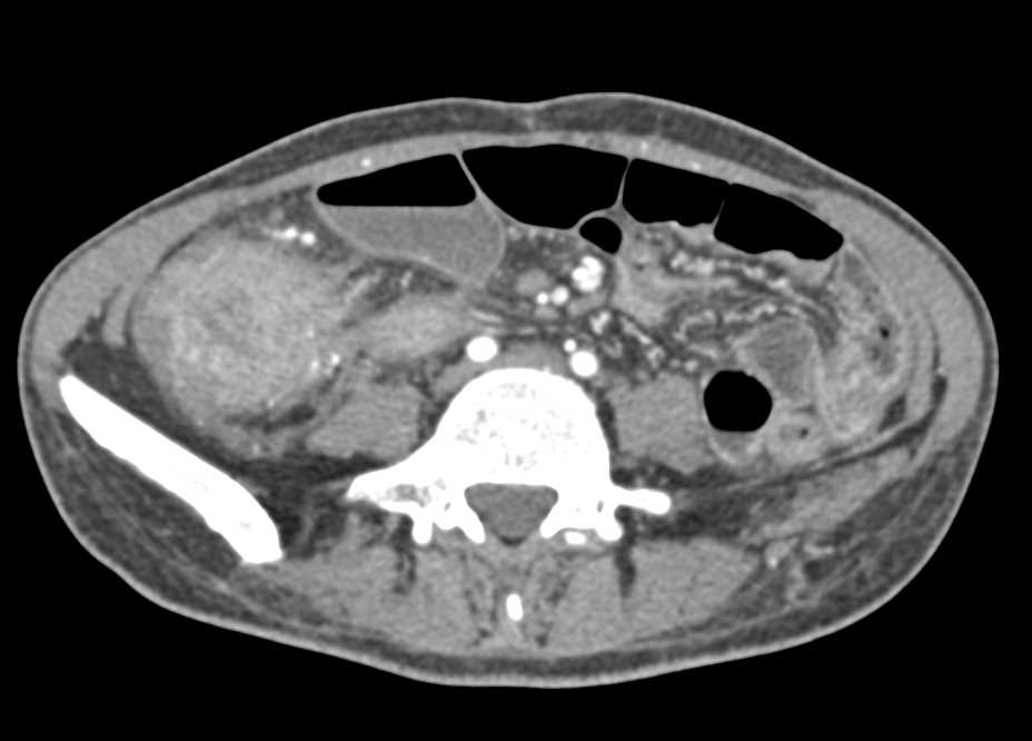 Acute Colitis Cecum with Inflammation - CTisus CT Scan