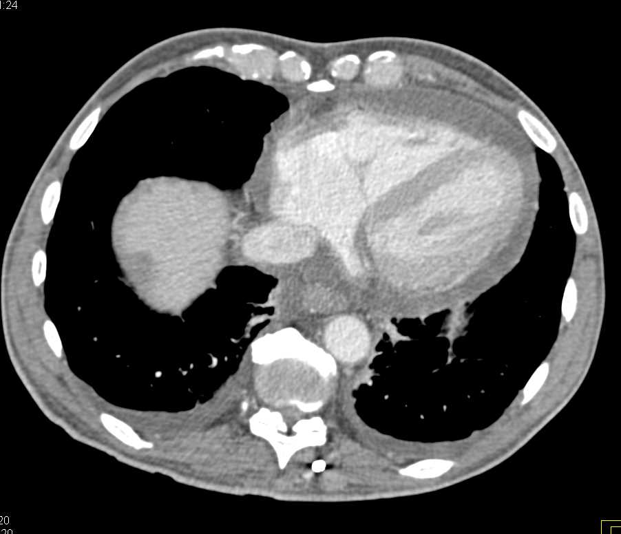 Perirectal Abscess in a Patient with Liver Metastases and Constrictive Pericarditis - CTisus CT Scan
