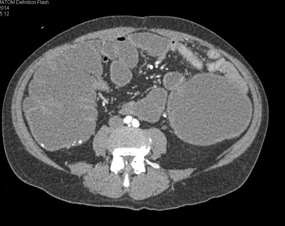 Rectal Cancer Obstructs the Colon - CTisus CT Scan