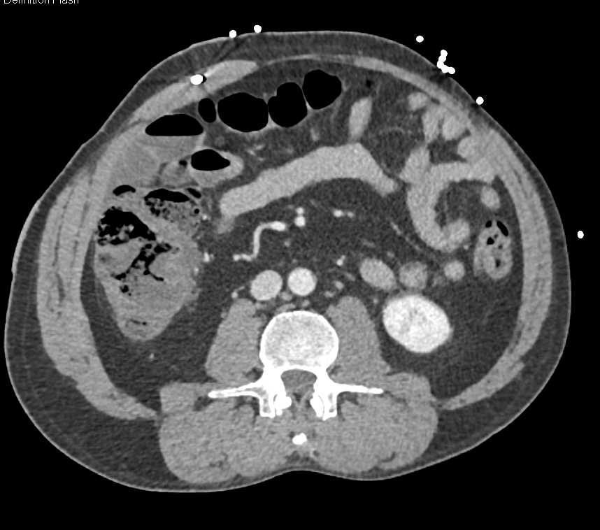 Cecal Carcinoma - CTisus CT Scan