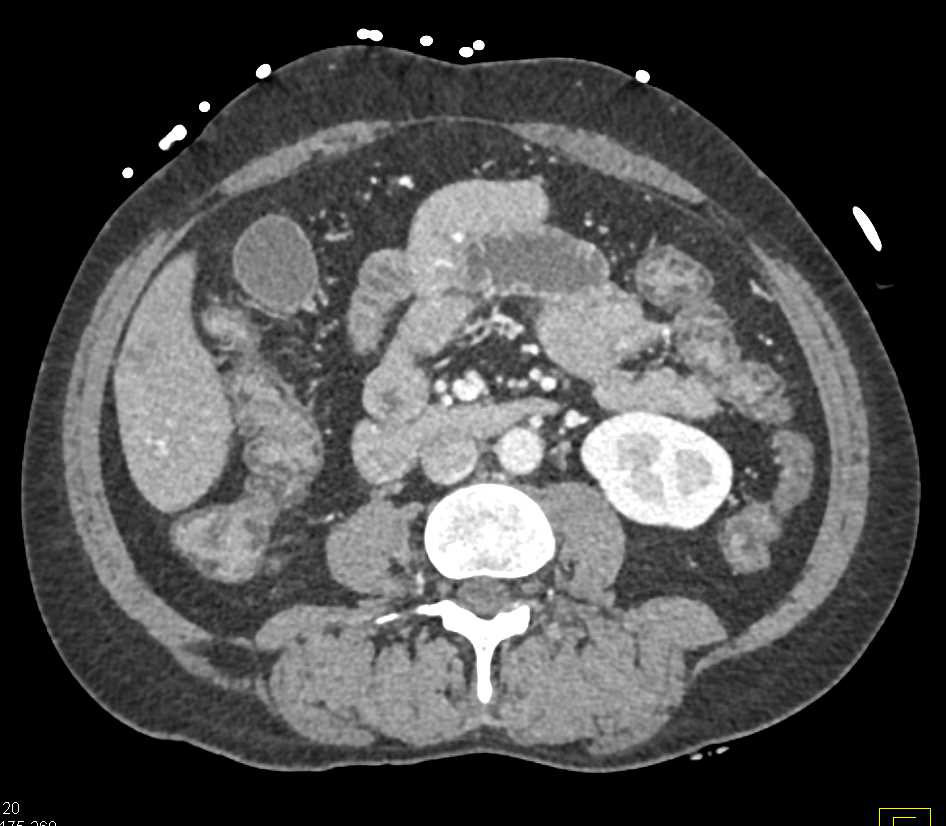 Ulcerative Colitis with Halo in Large Bowel - CTisus CT Scan