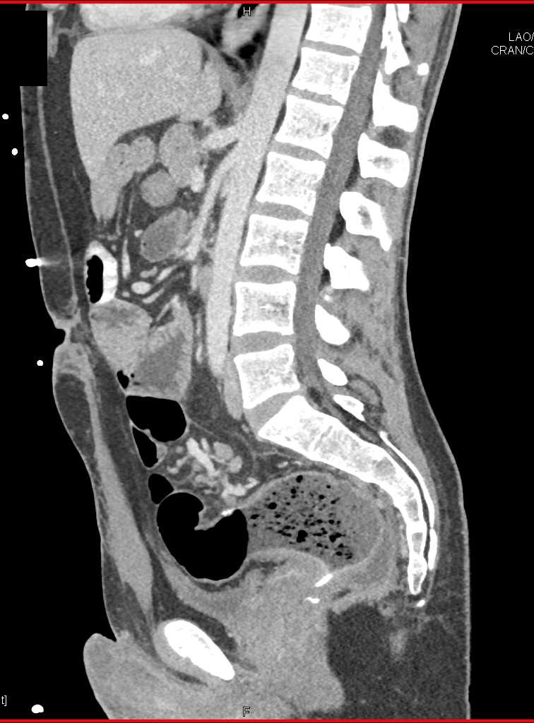 Inflamed Rectum with Colon Obstruction - CTisus CT Scan