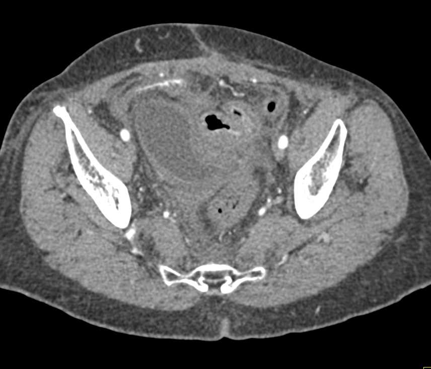 Severe Enteritis Distal Small Bowel due to Treatment - CTisus CT Scan