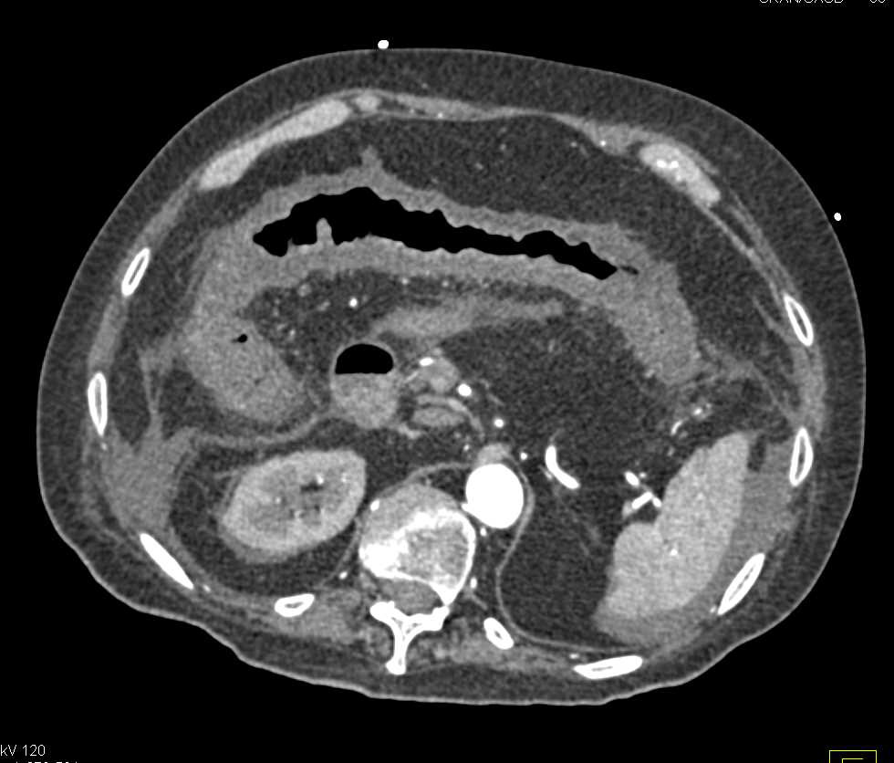 Pseuomembranous Colitis - CTisus CT Scan