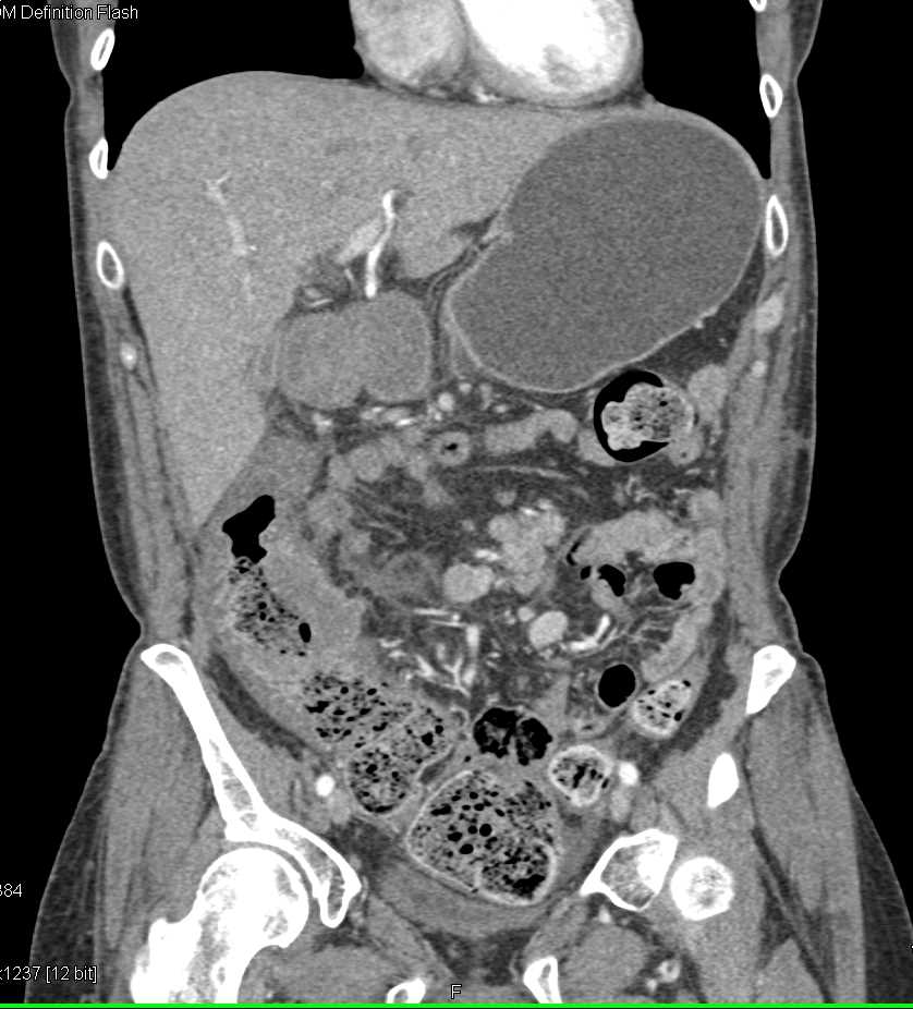 Carcinoma of the Right Colon - CTisus CT Scan