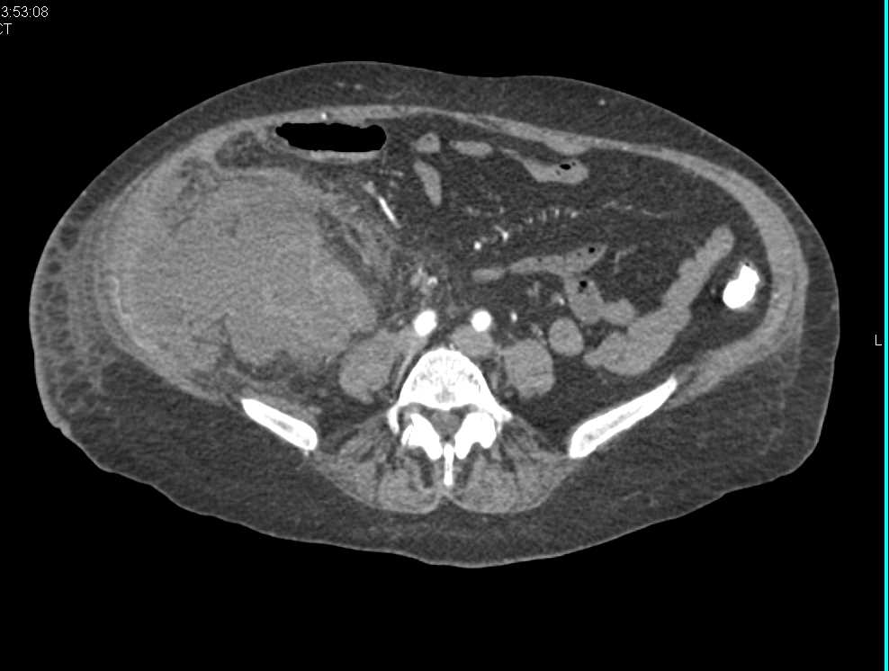Inflamed Right Colon and Appendix due to Colitis - CTisus CT Scan