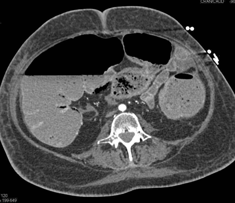 Colon Obstruction by a Colon Cancer - CTisus CT Scan