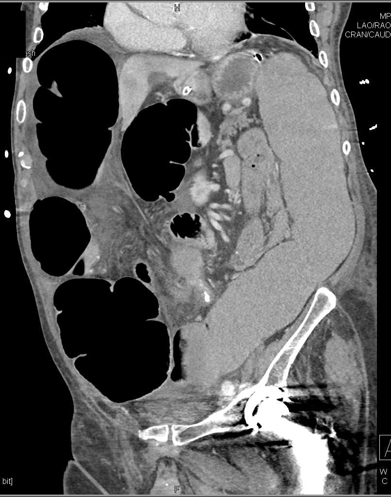 Sigmoid Volvulous - CTisus CT Scan