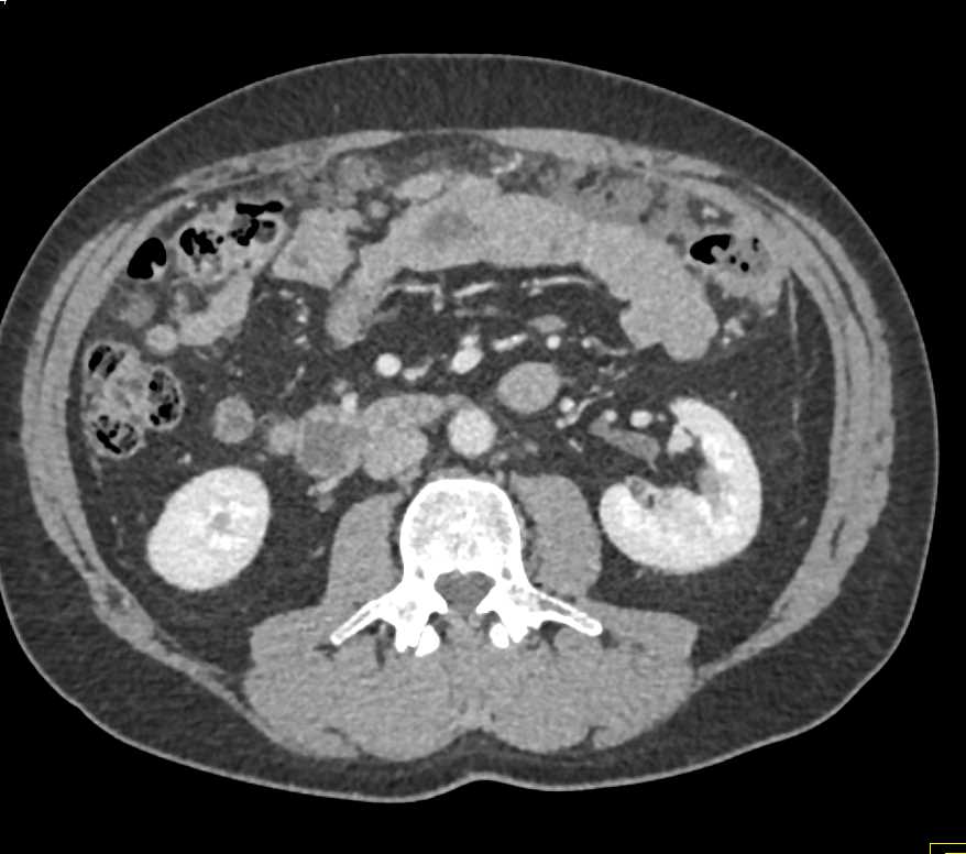 focal narrowing in the splenic flexture of the colon