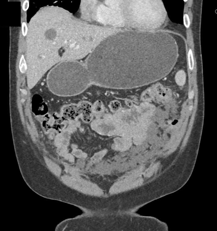 Carcinoma of the Splenic Flexure with Carcinomatosis - CTisus CT Scan