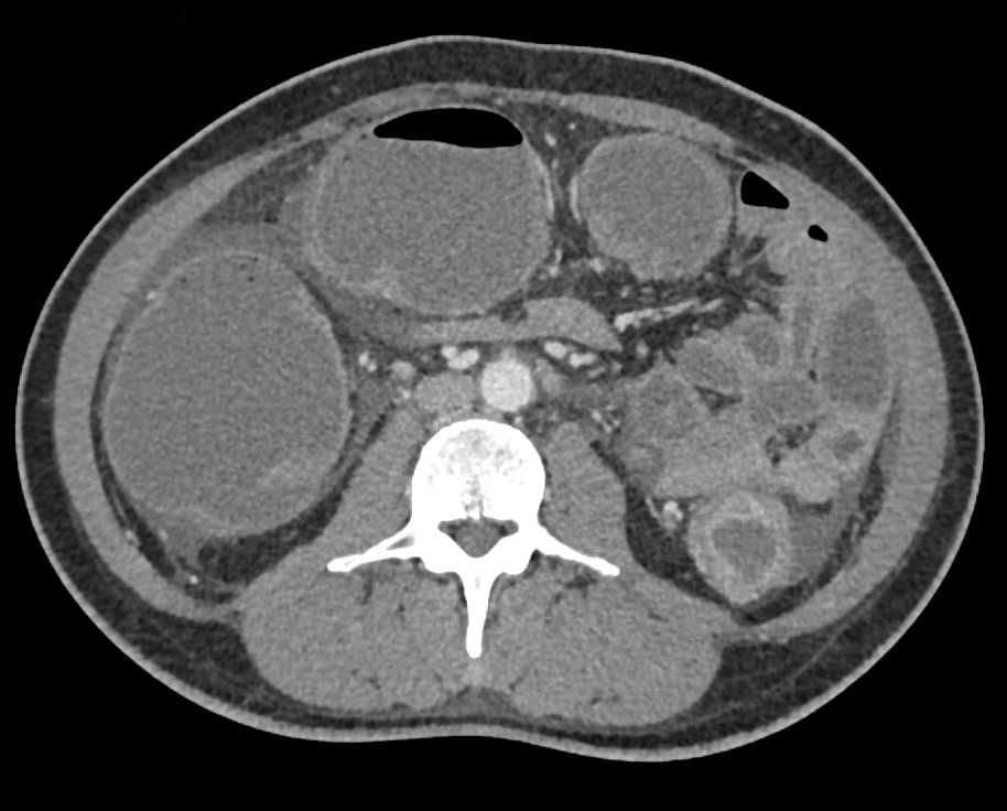 Hemorrhage in the Large Bowel - CTisus CT Scan