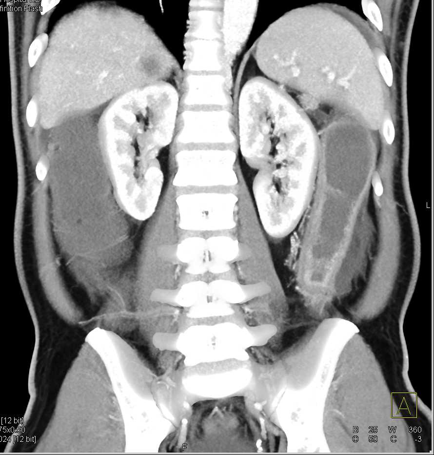 Hemorrhage in the Large Bowel  due to Colitis - CTisus CT Scan