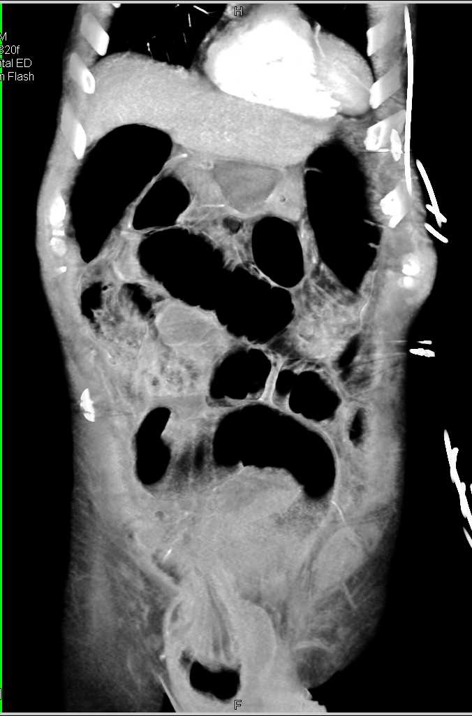 Small Bowel Obstruction (SBO) due to Small Bowel into a Incarcerated Inguinal Hernia - CTisus CT Scan