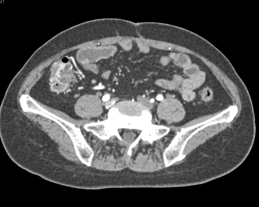 Vascular Dysplasias Right Colon - CTisus CT Scan