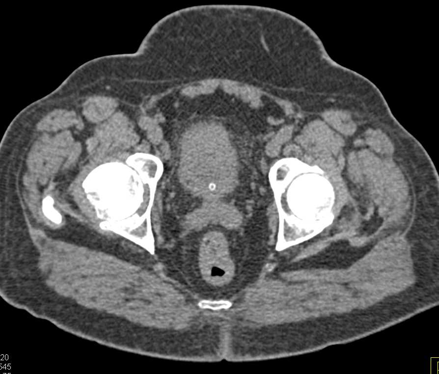 Colovesical Fistulae due to Cecal Carcinoma - CTisus CT Scan