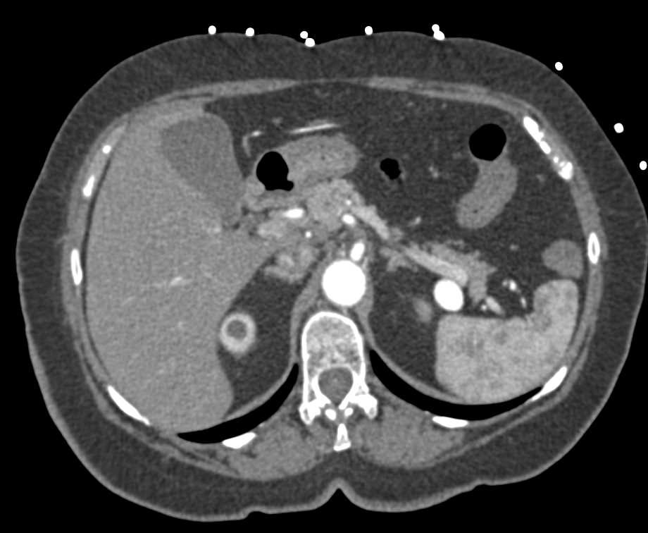 Pseudomembranous Colitis Left Colon - CTisus CT Scan