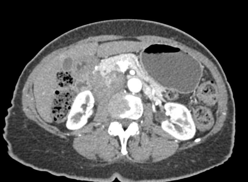 Large Node Near head of the Pancreas - CTisus CT Scan