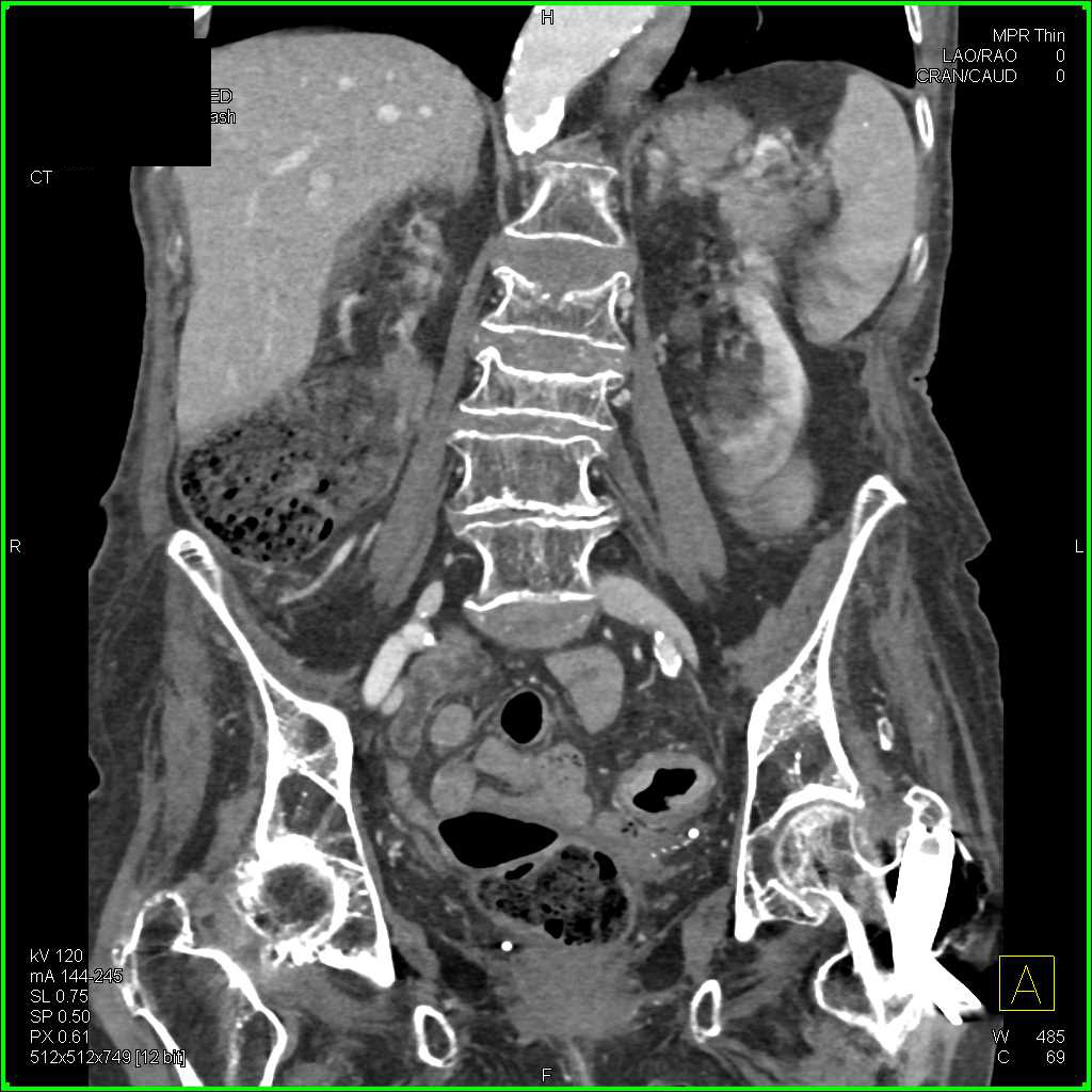 Pneumatosis of the Right Colon - CTisus CT Scan