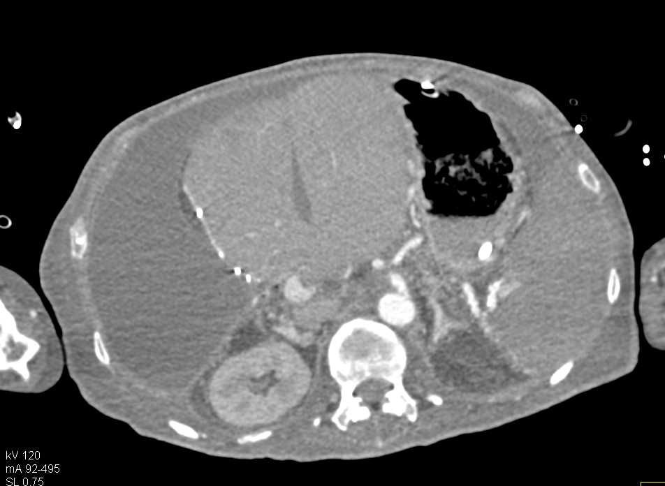 Ischemic Bowel with Pneumatosis - CTisus CT Scan
