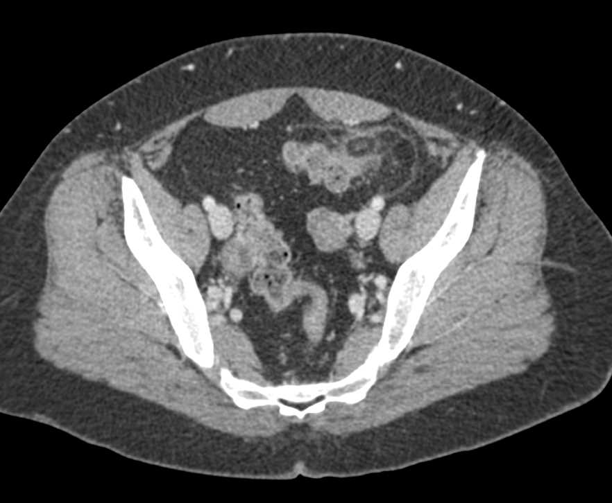 Appendix Epiploicae Involves Descending Colon - CTisus CT Scan