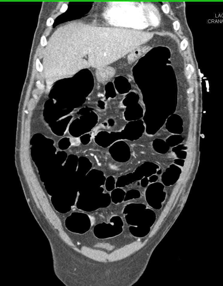 Stricture of Mid-Transverse Colon - CTisus CT Scan